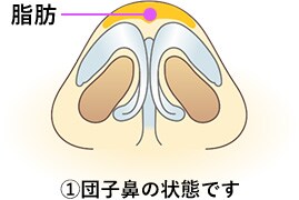 鼻尖形成術の手順1