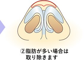 鼻尖形成術の手順2