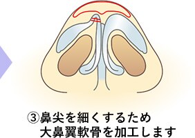 鼻尖形成術の手順3