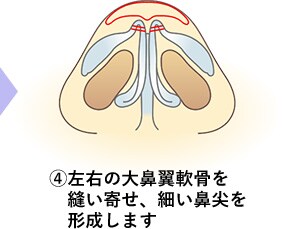 鼻尖形成術の手順4