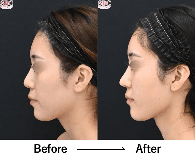 シャープ鼻セット(鼻尖形成術 + 鼻尖部軟骨移植)３ヶ月後