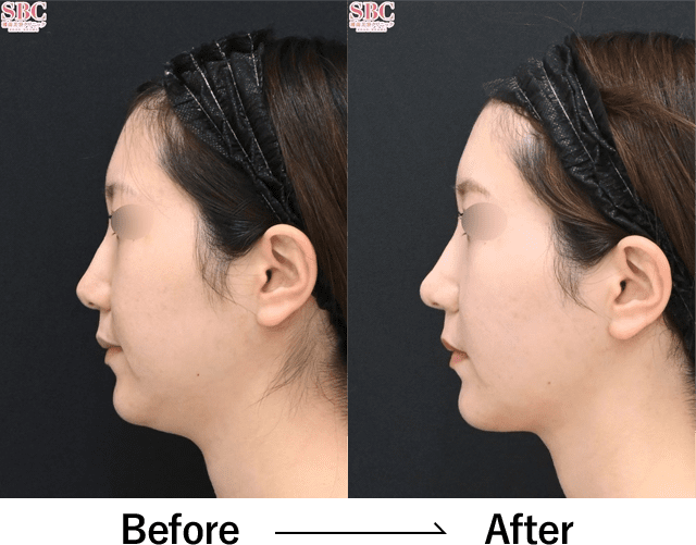 シャープ鼻セット(鼻尖形成術 + 鼻尖部軟骨移植)＋小鼻縮小(内側法＋締め付け縫合)３ヶ月後