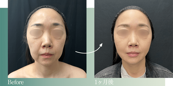 症例写真1