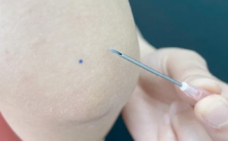 脂肪吸引注射の針