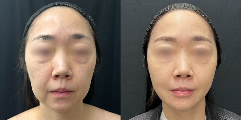 若返り施術 症例写真27