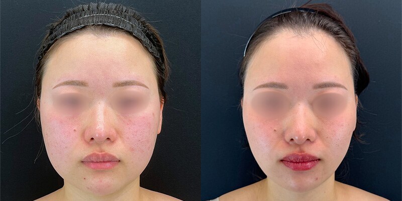 若返り施術 症例写真28