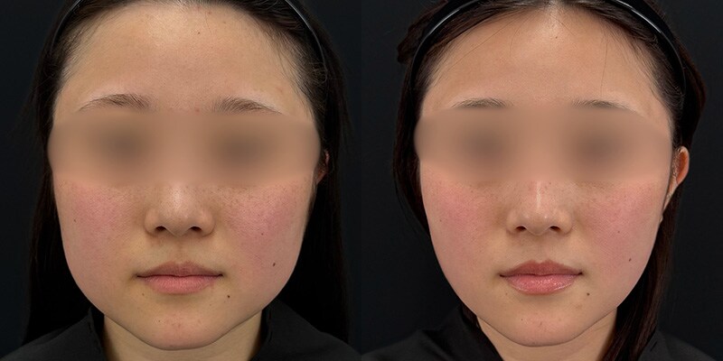 若返り施術 症例写真31