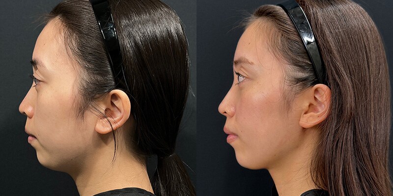 小顔施術 症例写真32