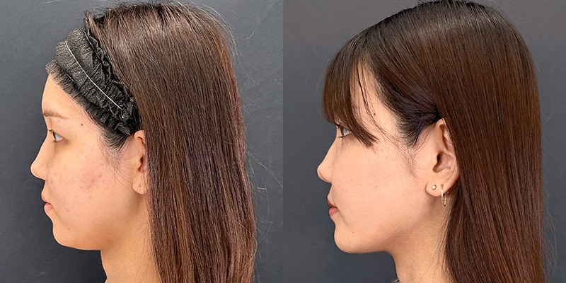 小顔施術 症例写真33