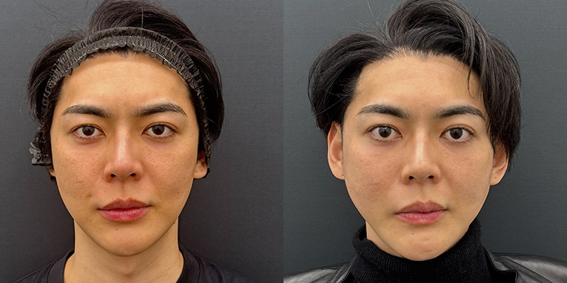 糸リフト症例写真
