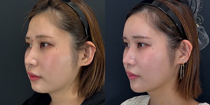 脂肪注入症例写真