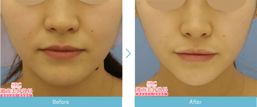 小顔整形 フェイスラインなら湘南美容クリニック 公式 美容整形 美容外科