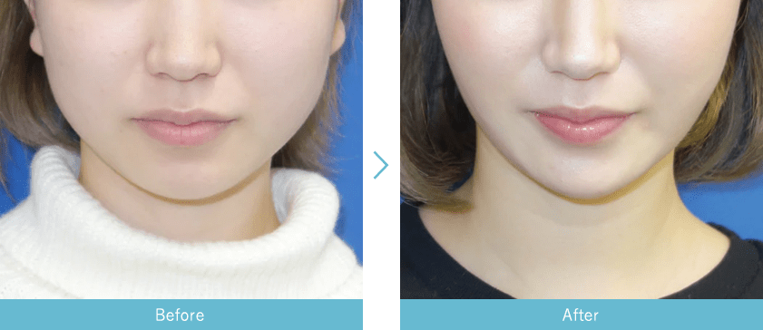小顔整形 フェイスラインなら湘南美容クリニック 公式 美容整形 美容外科 小顔整形 フェイスラインなら湘南美容クリニック 公式 美容整形 美容外科