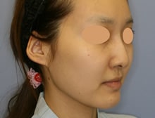 小顔整形 骨切り 小顔整形 フェイスラインなら湘南美容クリニック 公式 小顔整形 骨切り 小顔整形 フェイスラインなら湘南美容クリニック 公式