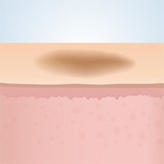 フラクショナルレーザー前