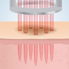 フラクショナルレーザー照射