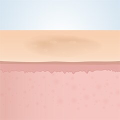 フラクショナルレーザー治療後