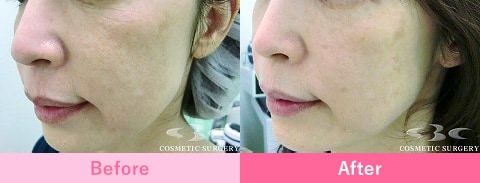 フラクショナルCO2レーザーの症例写真1