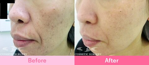 フラクショナルCO2レーザーの症例写真2