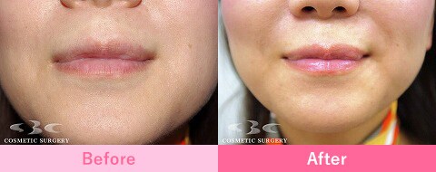 フラクショナルCO2レーザーの症例写真3