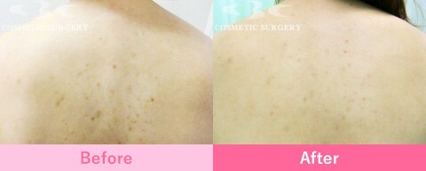 フラクショナルCO2レーザーの症例写真4