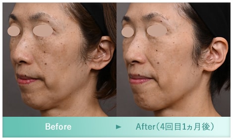 症例写真 Before After 1