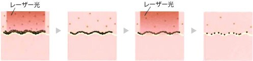 レーザートーニングの特徴