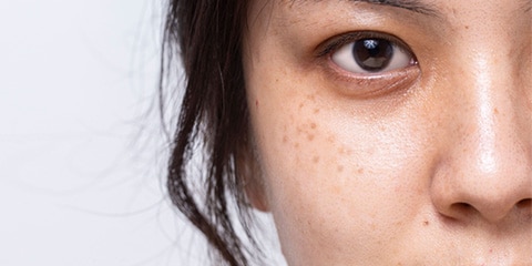 シミ取りレーザー治療の料金相場