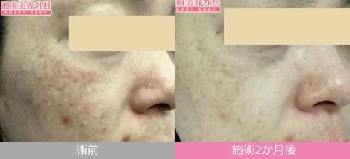サーマクールFLX/CPT+フラクショナルCO2レーザー 症例写真