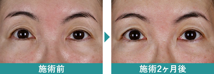 デンシティ 症例写真Before After