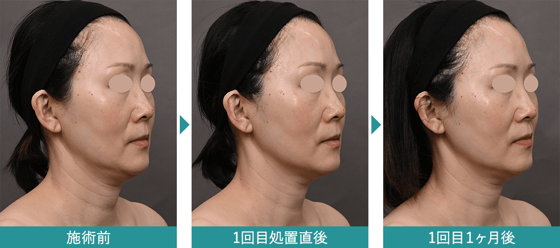 デンシティ 症例写真Before After