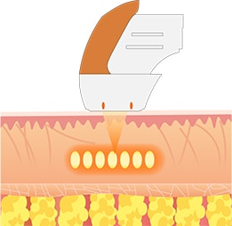 ノーマルモード（点状照射） イメージ