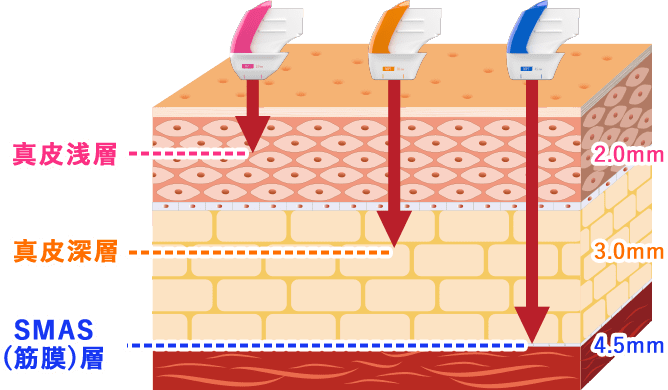 ３種類のチップを使用したエネルギー深達の使い分け イメージ