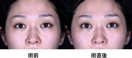 ウルトラリフトプラスhifu 医療レーザー外来なら湘南美容クリニック 公式