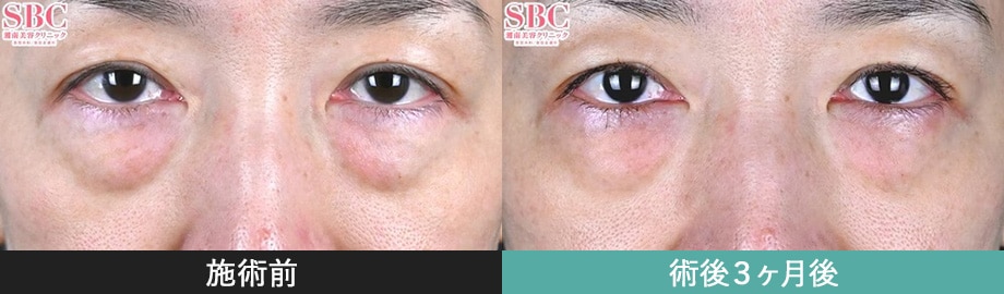 モフィウス8 症例写真 正面