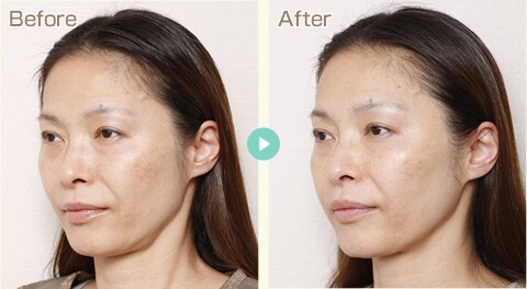 サーマタイトニング 医療レーザー外来なら湘南美容クリニック 公式