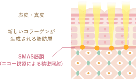 ウルセラ イメージ