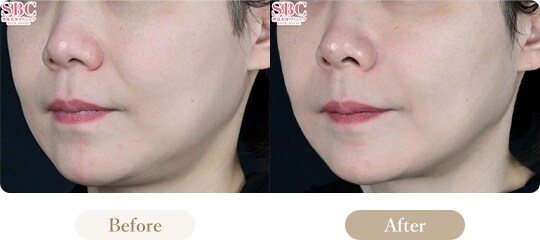 ウルセラの症例写真 Before After 1