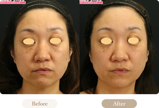 ウルセラの症例写真 Before After 3