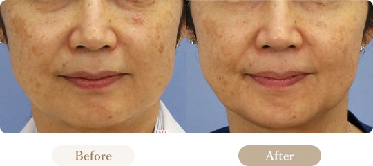 ウルセラの症例写真 Before After 4