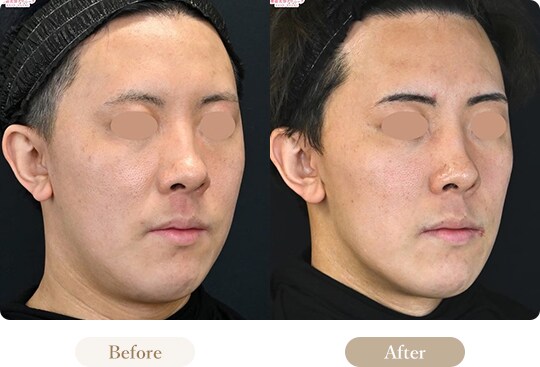 ウルセラのピックアップ症例写真 Before After 1