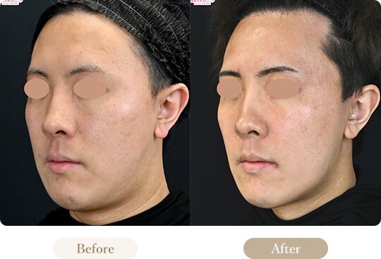 ウルセラのピックアップ症例写真 Before After 2