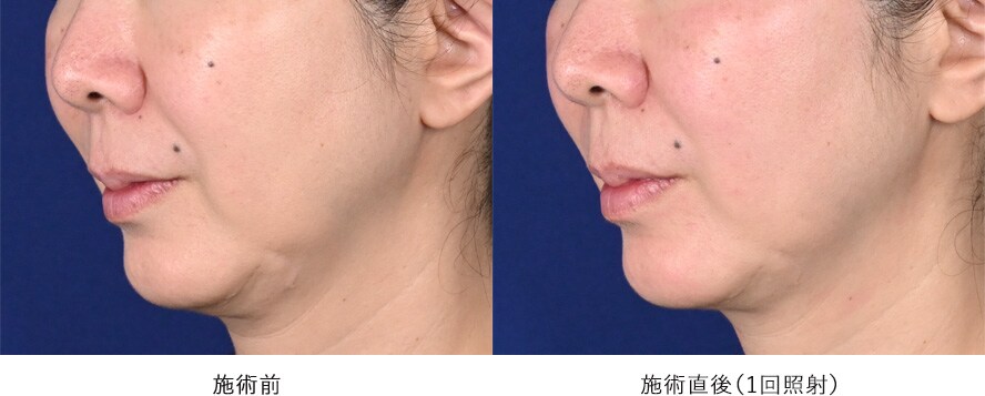 60代男性 ／ しわ、たるみのタイトニング 症例写真