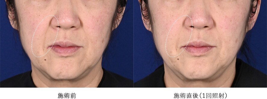 60代男性 ／ しわ、たるみのタイトニング 症例写真