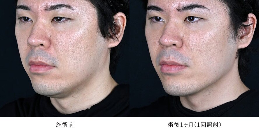 男性 ／ フェイスラインの引き締め 症例写真
