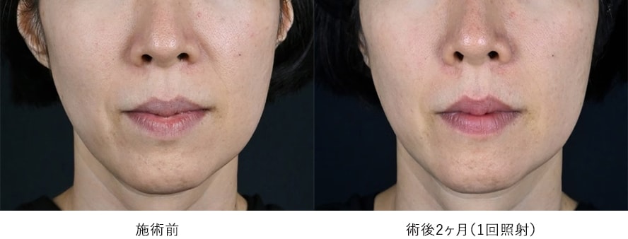 女性 ／ ほうれい線、マリオネットラインの改善