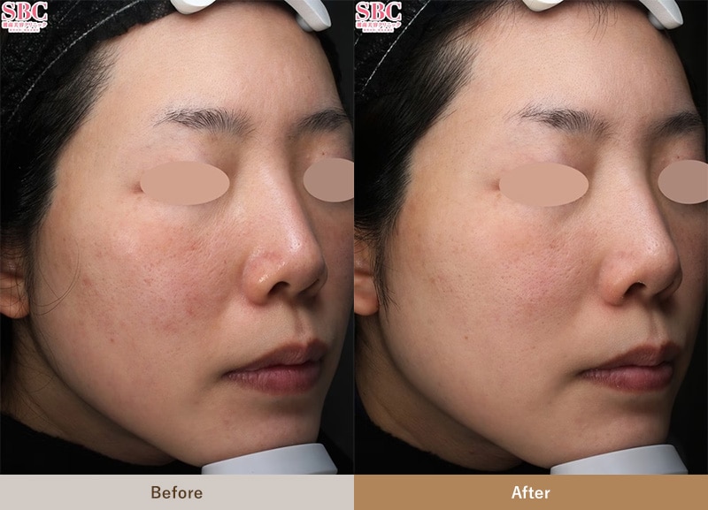 レーザー・導入・RF(高周波)治療による肝斑治療の症例