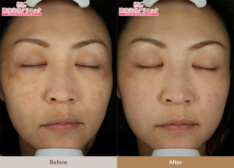 美容内服治療による肝斑治療の症例