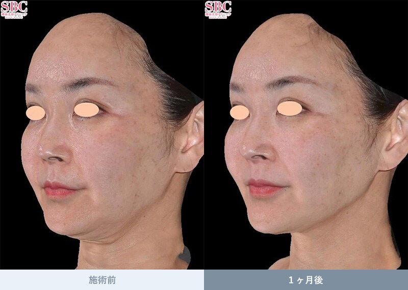 ウルトラリフトプラスHIFU 症例写真