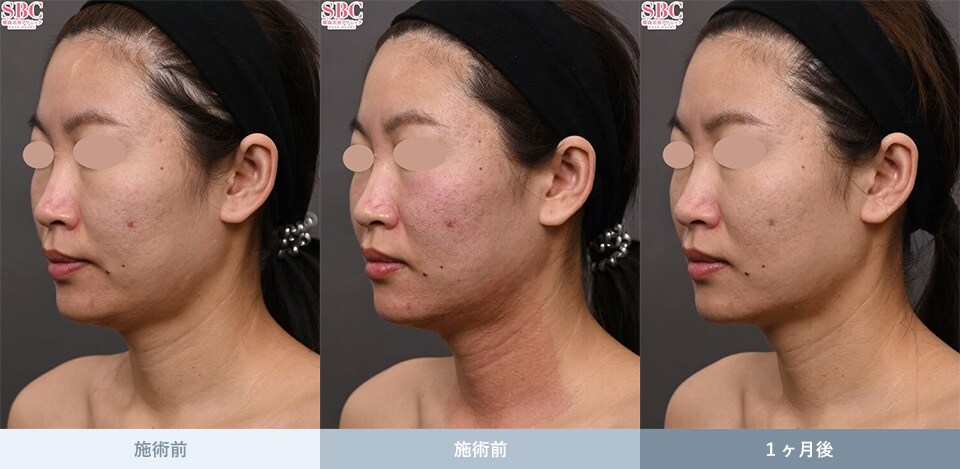 モフィウス8 症例写真